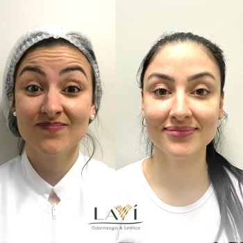 Botox-sao-jose-dos-campos1 1 (1)