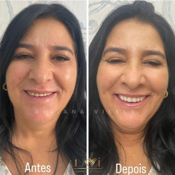 Clareamento-sao-jose-dos-campos1 1